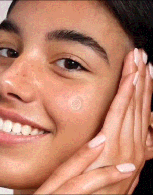 Microneedle Acne Patch